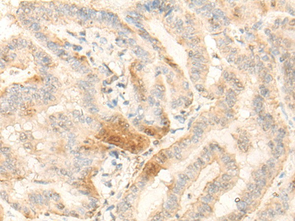 Immunohistochemistry of paraffin-embedded Human thyroid cancer tissue  using BZW2 Polyclonal Antibody at dilution of 1:25(?200)