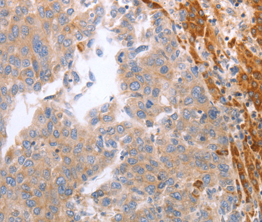 Immunohistochemistry of paraffin-embedded Human ovarian cancer tissue using NRTN Polyclonal Antibody at dilution 1:60