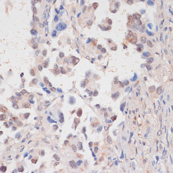 Immunohistochemistry of paraffin-embedded Human lung cancer using HTATSF1 Polyclonal Antibody at dilution of 1:100 (40x lens).