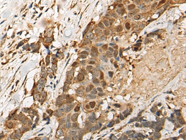 Immunohistochemistry of paraffin-embedded Human thyroid cancer tissue  using HEATR9 Polyclonal Antibody at dilution of 1:110(?200)