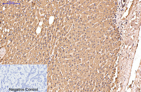 Immunohistochemistry of paraffin-embedded Human liver cancer tissue using IDE Monoclonal Antibody at dilution of 1:200.