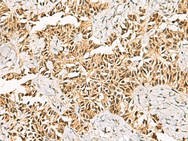 Immunohistochemistry of paraffin-embedded Human ovarian cancer tissue  using LRIF1 Polyclonal Antibody at dilution of 1:70(?200)