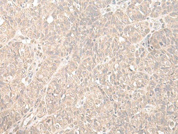 Immunohistochemistry of paraffin-embedded Human ovarian cancer tissue  using HENMT1 Polyclonal Antibody at dilution of 1:35(?200)