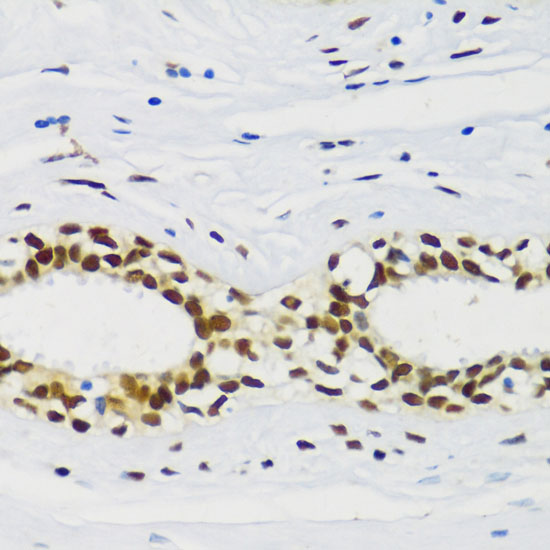Immunohistochemistry of paraffin-embedded human breast cancer using CIRBP Polyclonal Antibody at dilution of 1:100 (40x lens).Perform microwave antigen retrieval with 10 mM PBS buffer pH 7.2 before commencing with IHC staining protocol.