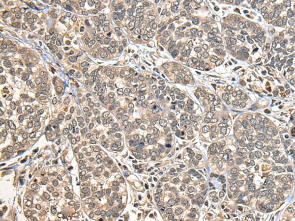 Immunohistochemistry of paraffin-embedded Human esophagus cancer tissue  using DGKI Polyclonal Antibody at dilution of 1:30(?200)