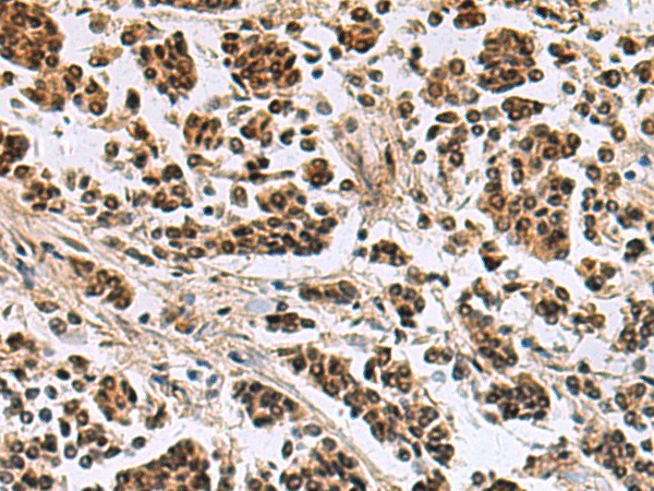 Immunohistochemistry of paraffin-embedded Human breast cancer tissue  using SIK3 Polyclonal Antibody at dilution of 1:60(?200)