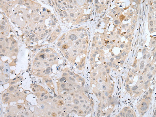 Immunohistochemistry of paraffin-embedded Human esophagus cancer tissue  using BORCS8 Polyclonal Antibody at dilution of 1:50(?200)