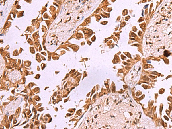 Immunohistochemistry of paraffin-embedded Human lung cancer tissue  using IRX1 Polyclonal Antibody at dilution of 1:35(?200)