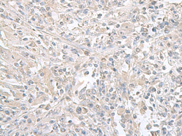 Immunohistochemistry of paraffin-embedded Human liver cancer tissue  using FXYD6 Polyclonal Antibody at dilution of 1:65(?200)