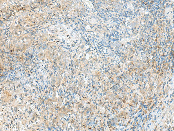 Immunohistochemistry of paraffin-embedded Human cervical cancer tissue  using RPP14 Polyclonal Antibody at dilution of 1:60(?200)