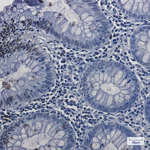 Immunohistochemistry of Topoisomerase I in paraffin-embedded Human colon cancer tissue using Topoisomerase I Rabbit mAb at dilution 1:50