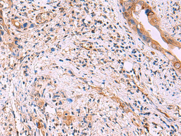 Immunohistochemistry of paraffin-embedded Human cervical cancer tissue  using ZAP70 Polyclonal Antibody at dilution of 1:55(?200)