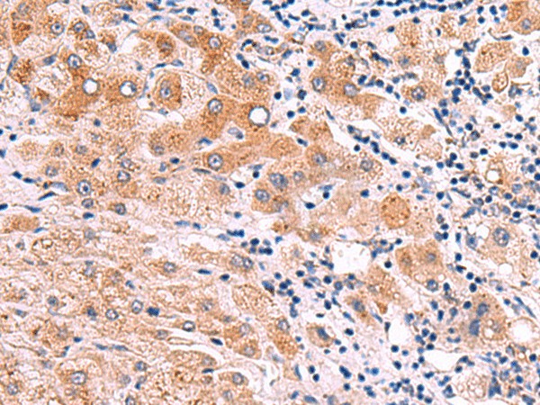 Immunohistochemistry of paraffin-embedded Human liver cancer tissue  using ITGA11 Polyclonal Antibody at dilution of 1:75(?200)