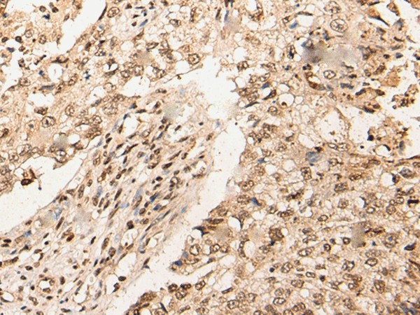 Immunohistochemistry of paraffin-embedded Human lung cancer tissue  using URI1 Polyclonal Antibody at dilution of 1:45(?200)