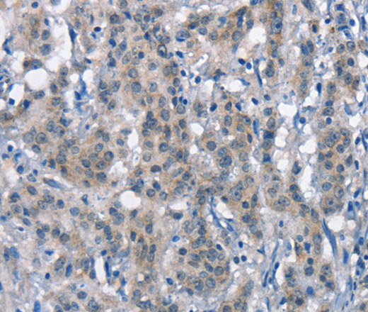 Immunohistochemistry of paraffin-embedded Human gastric cancer tissue using CD226 Polyclonal Antibody at dilution 1:60