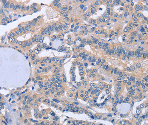 Immunohistochemistry of paraffin-embedded Human thyroid cancer tissue using BOD1 Polyclonal Antibody at dilution 1:60