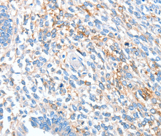 Immunohistochemistry of paraffin-embedded Human ovarian cancer using ALDH1A2 Polyclonal Antibody at dilution of 1:60