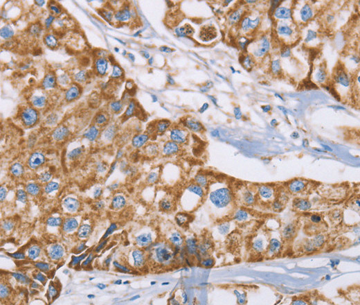 Immunohistochemistry of paraffin-embedded Human breast cancer tissue using GUCY1A3 Polyclonal Antibody at dilution 1:40