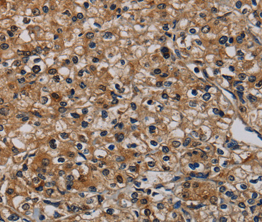 Immunohistochemistry of paraffin-embedded Human prostate cancer using TP53INP1 Polyclonal Antibody at dilution of 1:50