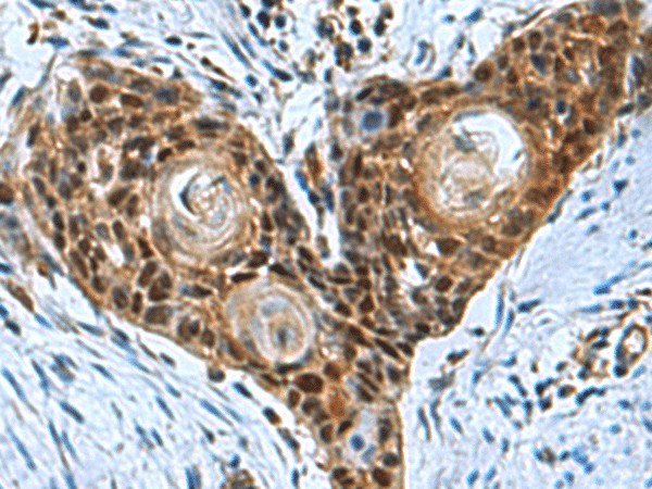 Immunohistochemistry of paraffin-embedded Human esophagus cancer tissue  using ITGB1BP1 Polyclonal Antibody at dilution of 1:50(?200)