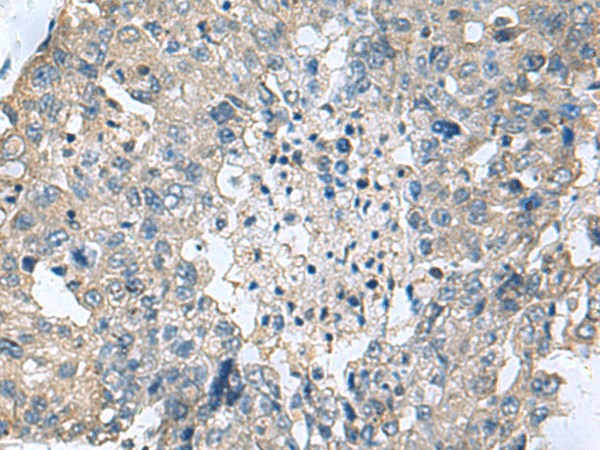 Immunohistochemistry of paraffin-embedded Human liver cancer tissue  using TGM3 Polyclonal Antibody at dilution of 1:55(?200)