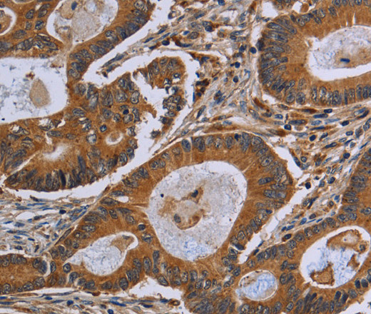 Immunohistochemistry of paraffin-embedded Human colon cancer using GJB4 Polyclonal Antibody at dilution of 1:40