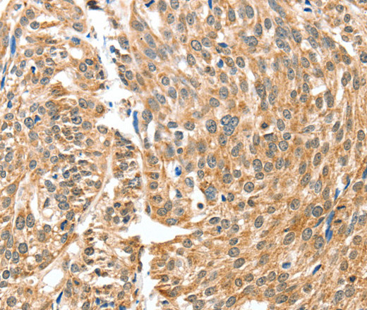 Immunohistochemistry of paraffin-embedded Human esophagus cancer using BAX Polyclonal Antibody at dilution of 1:30