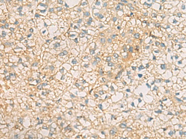 Immunohistochemistry of paraffin-embedded Human liver cancer tissue  using MRPL9 Polyclonal Antibody at dilution of 1:60(?200)