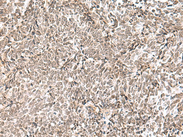 Immunohistochemistry of paraffin-embedded Human lung cancer tissue  using ELAC1 Polyclonal Antibody at dilution of 1:65(?200)