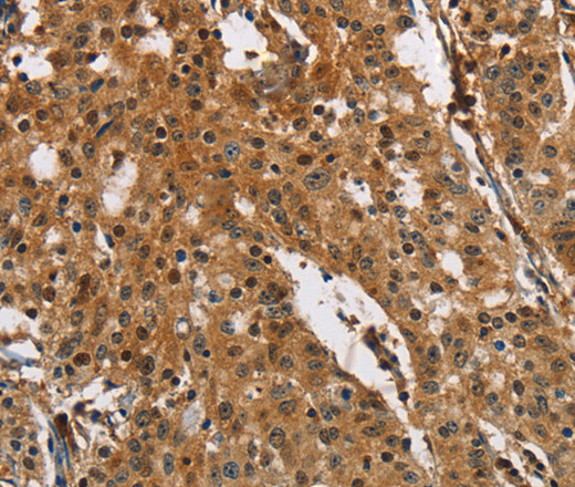 Immunohistochemistry of paraffin-embedded Human gasrtic cancer tissue using PTK6 Polyclonal Antibody at dilution 1:40