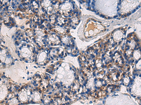 Immunohistochemistry of paraffin-embedded Human thyroid cancer tissue  using ABHD14B Polyclonal Antibody at dilution of 1:60(?200)