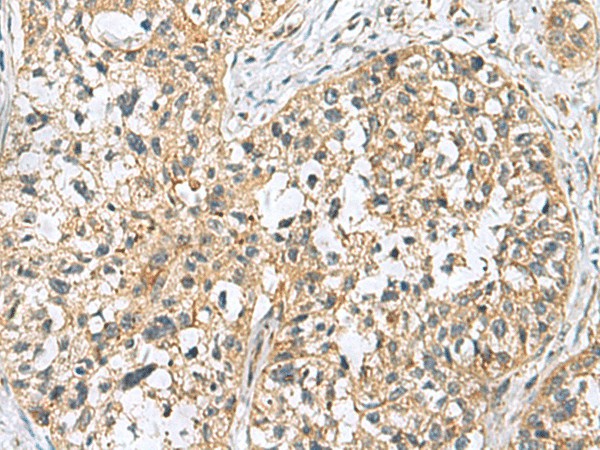 Immunohistochemistry of paraffin-embedded Human esophagus cancer tissue  using SKI Polyclonal Antibody at dilution of 1:70(?200)