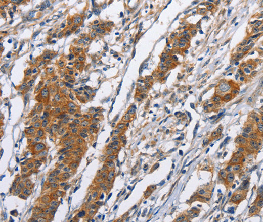 Immunohistochemistry of paraffin-embedded Human gasrtic cancer tissue using NCAPD3 Polyclonal Antibody at dilution 1:50