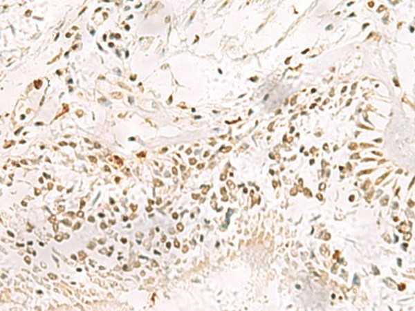 Immunohistochemistry of paraffin-embedded Human lung cancer tissue  using PDS5A Polyclonal Antibody at dilution of 1:90(?200)