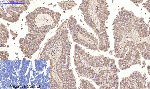 Immunohistochemistry of paraffin-embedded Human lung cancer tissue using CA9 Monoclonal Antibody at dilution of 1:200.