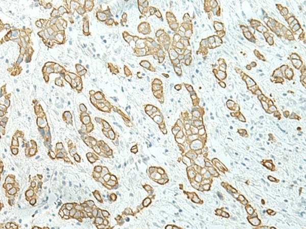 Immunohistochemistry of paraffin-embedded Human breast cancer tissue  using ETAA1 Polyclonal Antibody at dilution of 1:40(?200)