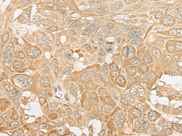 Immunohistochemistry of paraffin-embedded Human esophagus cancer tissue  using ROM1 Polyclonal Antibody at dilution of 1:30(?200)