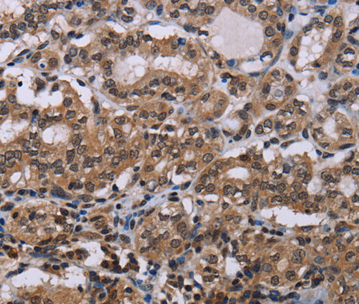 Immunohistochemistry of paraffin-embedded Human thyroid cancer tissue using DLX4 Polyclonal Antibody at dilution 1:50