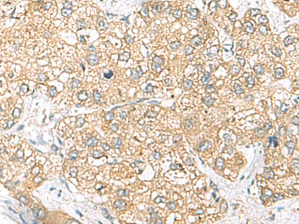 Immunohistochemistry of paraffin-embedded Human liver cancer tissue  using SH3GL2 Polyclonal Antibody at dilution of 1:45(?200)