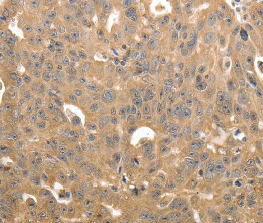 Immunohistochemistry of paraffin-embedded Human ovarian cancer using STX1A Polyclonal Antibody at dilution of 1:40