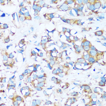 Immunohistochemistry of paraffin-embedded Human breast cancer using ARHGEF5 Polyclonal Antibody at dilution of  1:100 (40x lens).