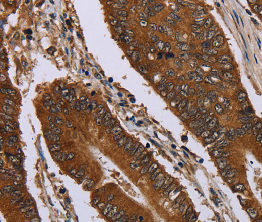 Immunohistochemistry of paraffin-embedded Human colon cancer using Catenin gamma Polyclonal Antibody at dilution of 1:40