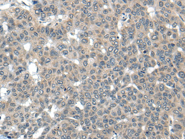 Immunohistochemistry of paraffin-embedded Human liver cancer tissue  using CARD16 Polyclonal Antibody at dilution of 1:55(?200)