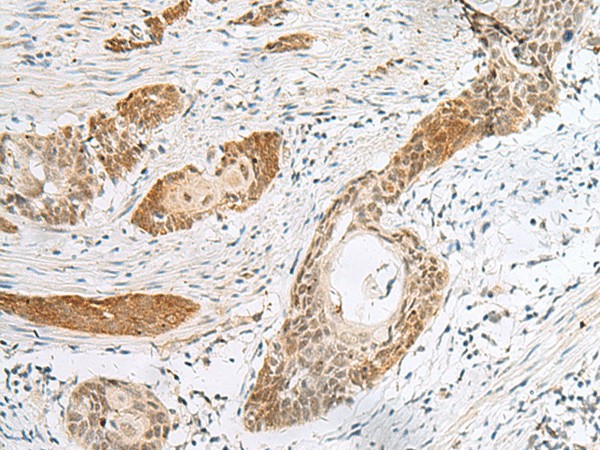 Immunohistochemistry of paraffin-embedded Human esophagus cancer tissue  using HIST1H2BK Polyclonal Antibody at dilution of 1:40(?200)