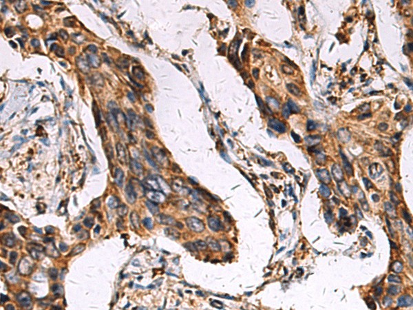 Immunohistochemistry of paraffin-embedded Human breast cancer tissue  using ECM1 Polyclonal Antibody at dilution of 1:45(?200)