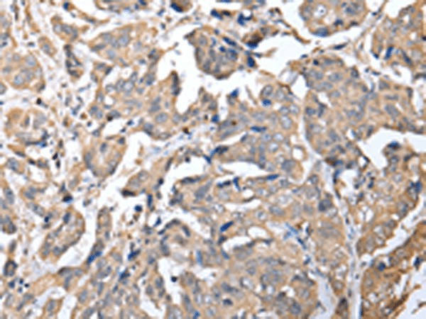 Immunohistochemistry of paraffin-embedded Human breast cancer tissue  using KCTD16 Polyclonal Antibody at dilution of 1:25(?200)