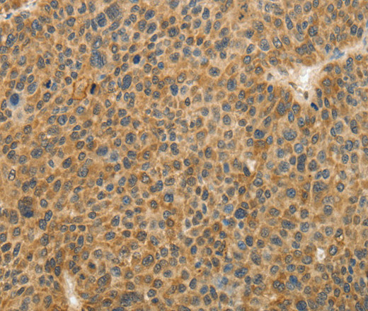 Immunohistochemistry of paraffin-embedded Human liver cancer tissue using TFPI2 Polyclonal Antibody at dilution 1:30