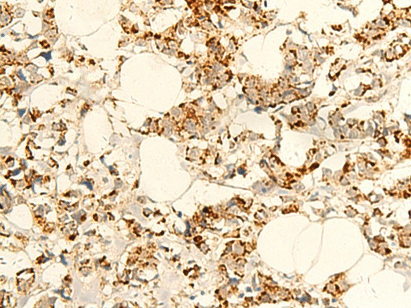 Immunohistochemistry of paraffin-embedded Human breast cancer tissue  using NAPRT Polyclonal Antibody at dilution of 1:50(?200)