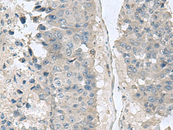 Immunohistochemistry of paraffin-embedded Human liver cancer tissue  using NPHP1 Polyclonal Antibody at dilution of 1:60(?200)