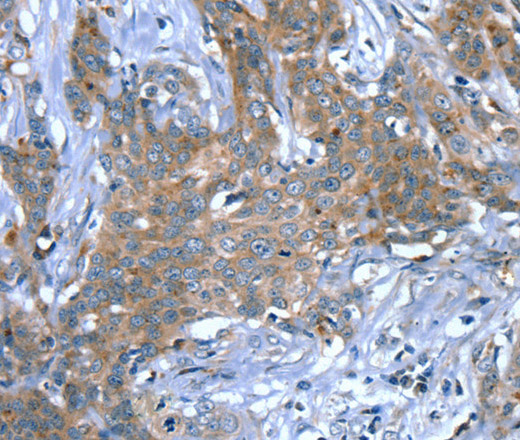 Immunohistochemistry of paraffin-embedded Human cervical cancer using SCPEP1 Polyclonal Antibody at dilution of 1:30